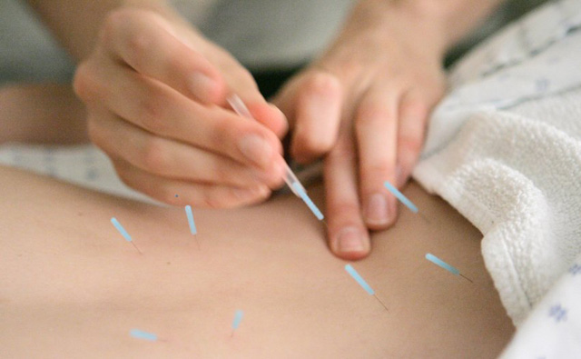 acupuncture