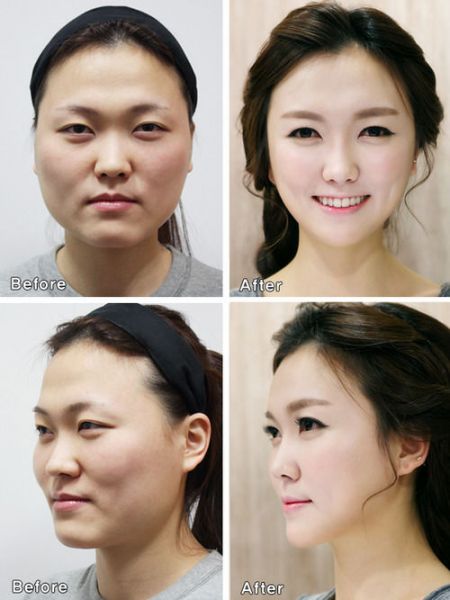 (miniature) Chirurgie esthétique: Opérées en Corée, elles ont du mal à repasser la frontière